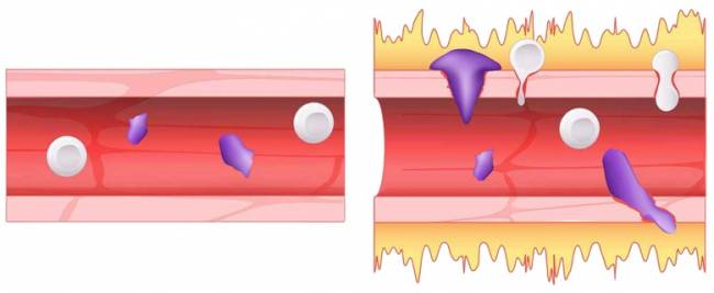 covid 19 hyperactivite bradykinine vaisseau sanguin